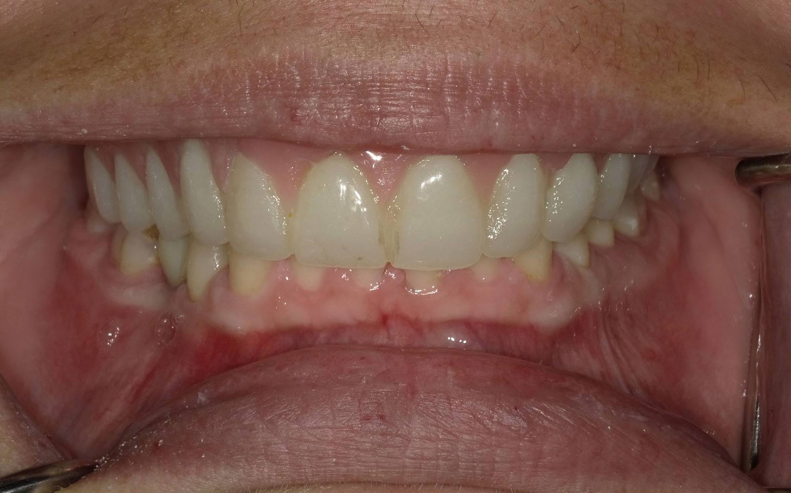 Implant-supported-fixed-denture-hybrid-After