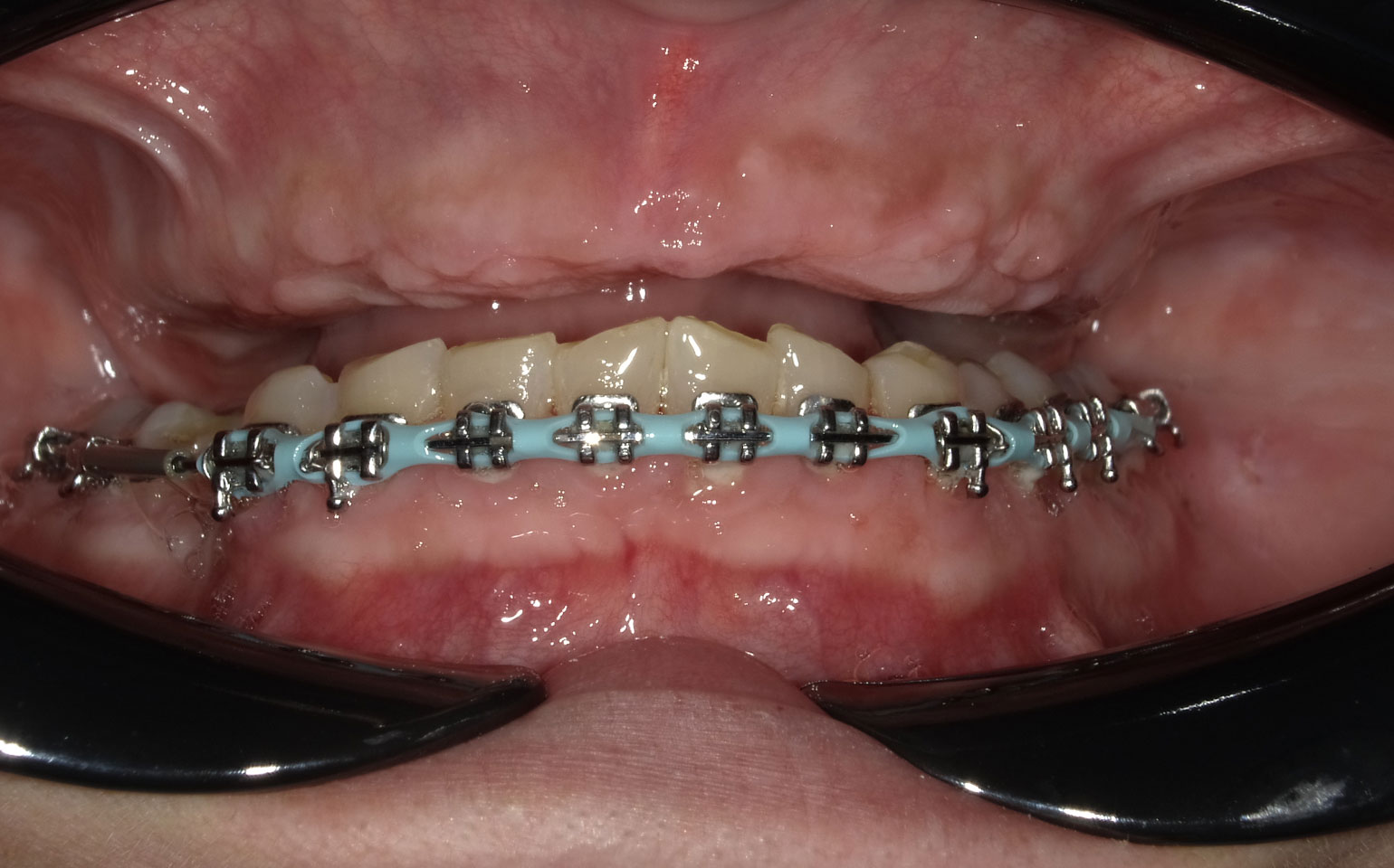 Implant-supported-fixed-denture-hybrid-before