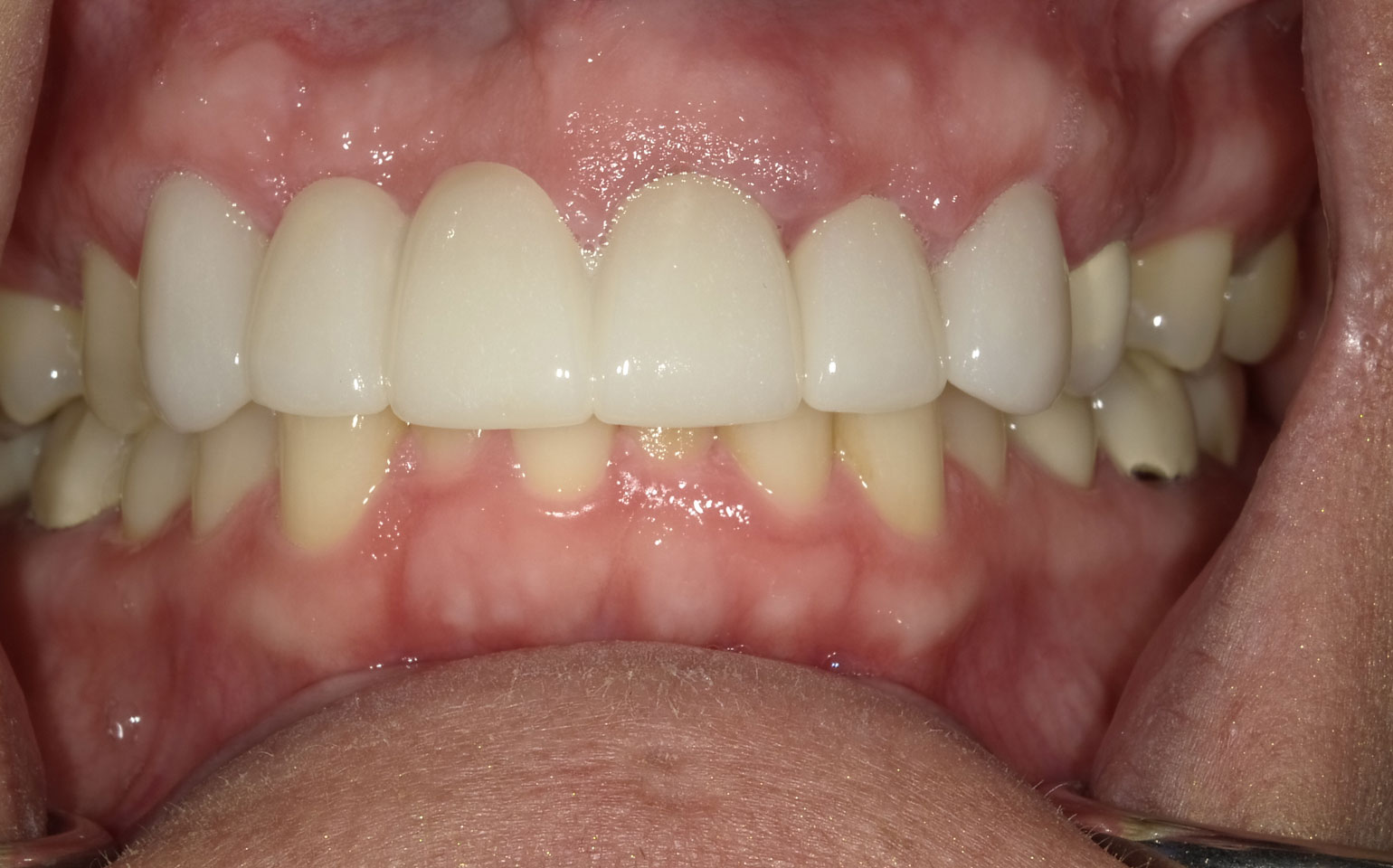 Dental Crowns and Bridges After