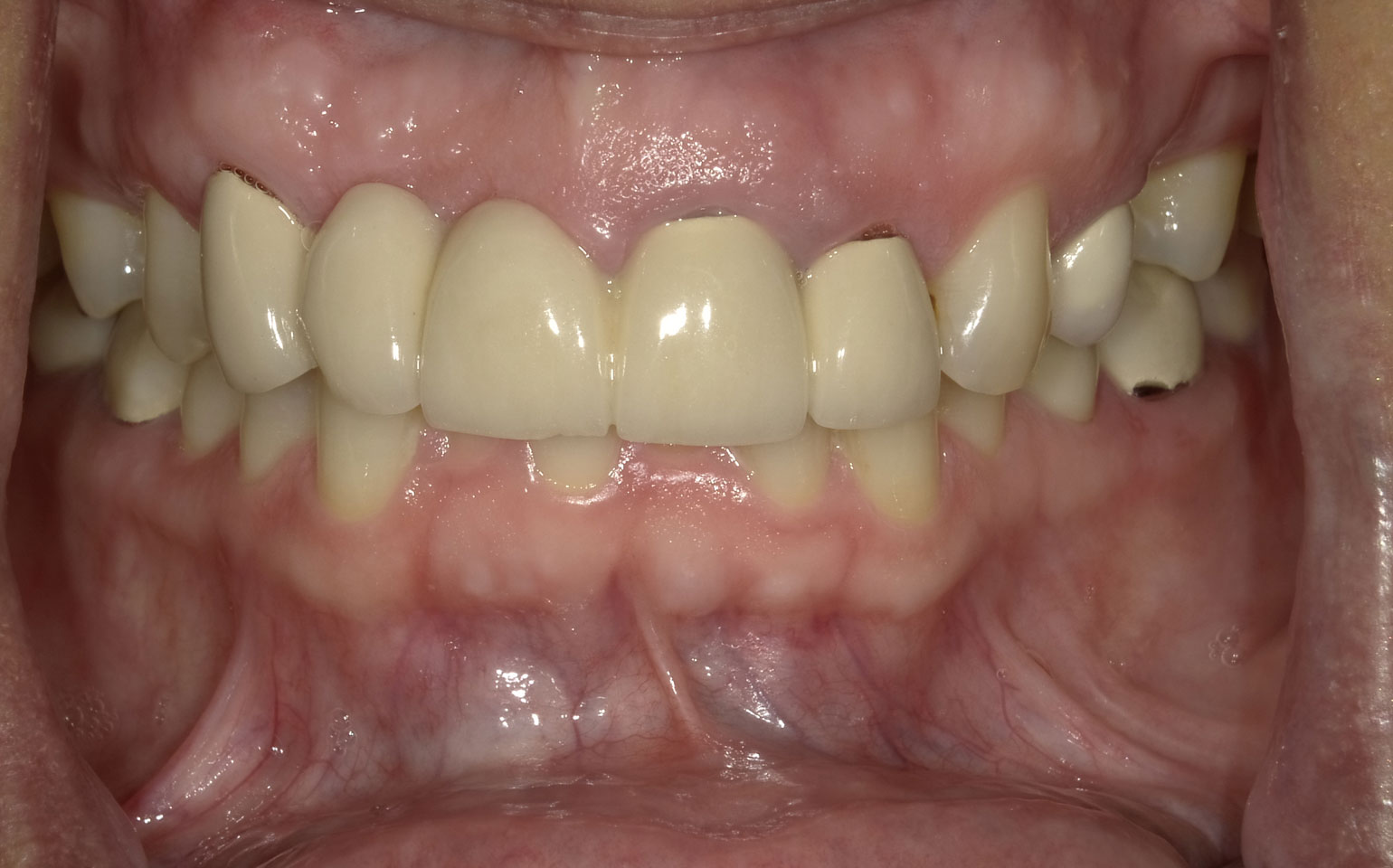 Dental Crowns and Bridges Before