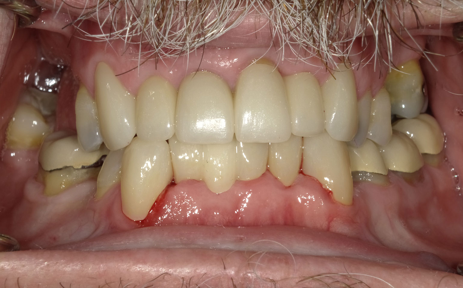 Dental Crowns and Bridges After