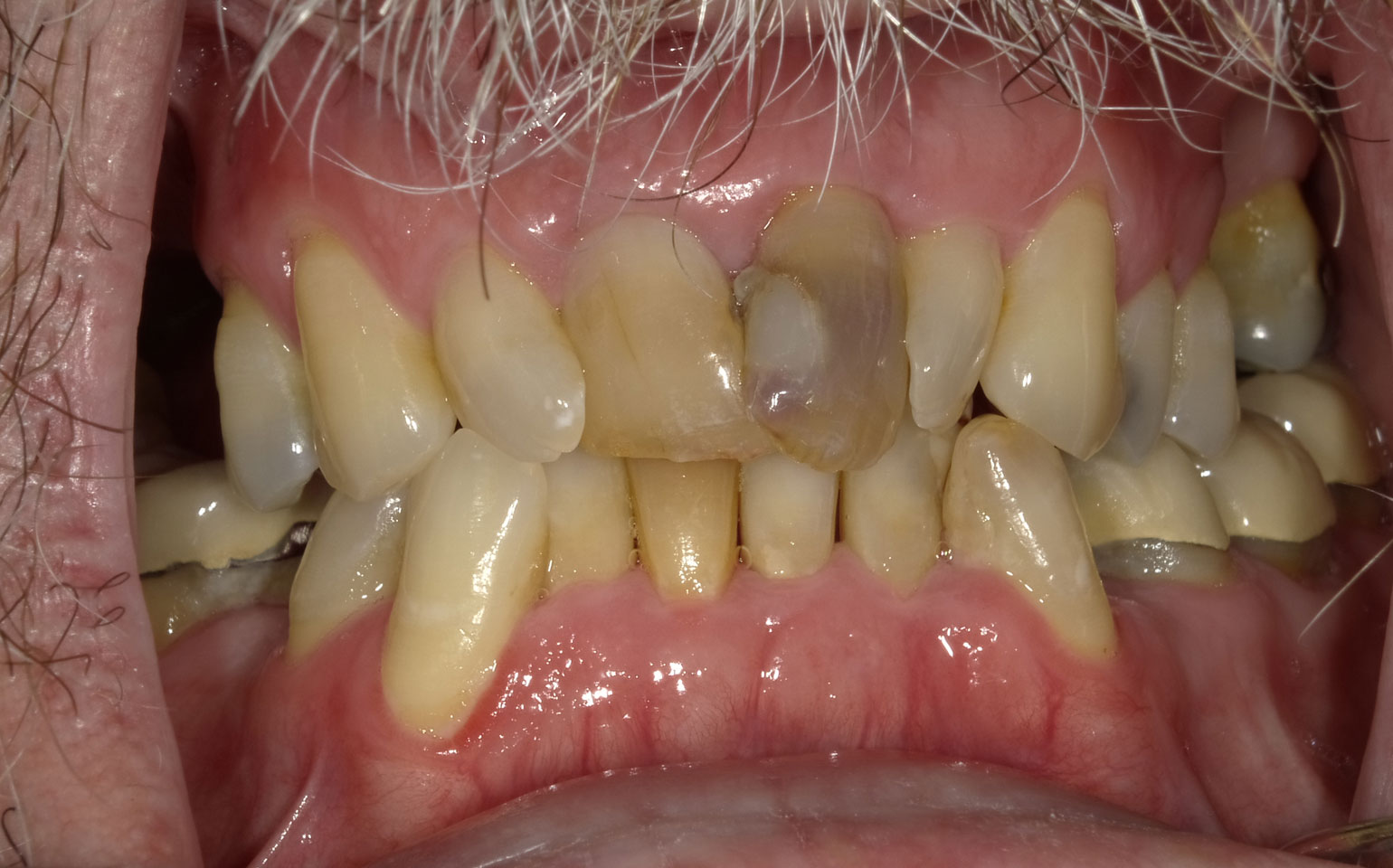 Dental Crowns and Bridges Before