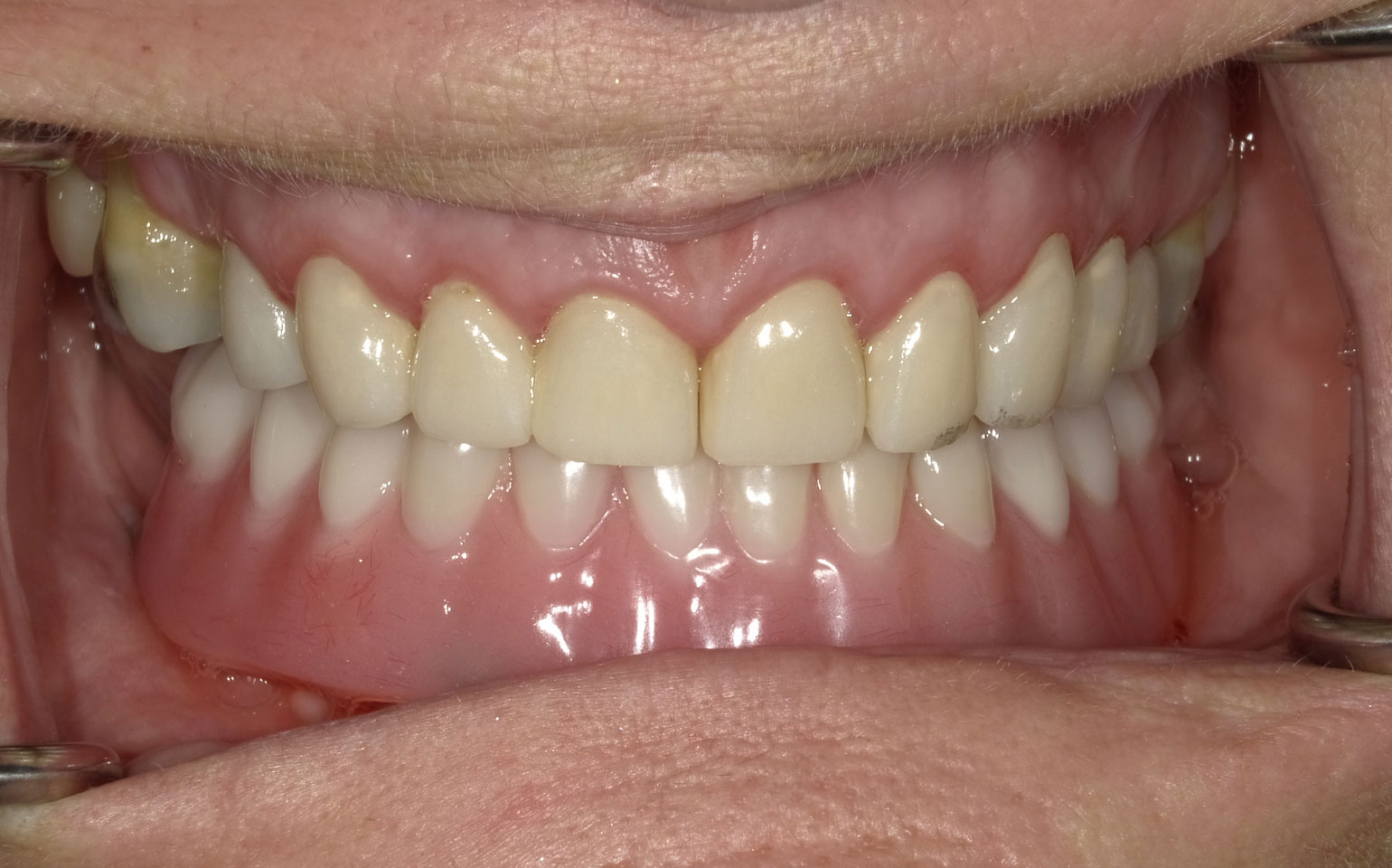 Dental Crowns and Bridges After