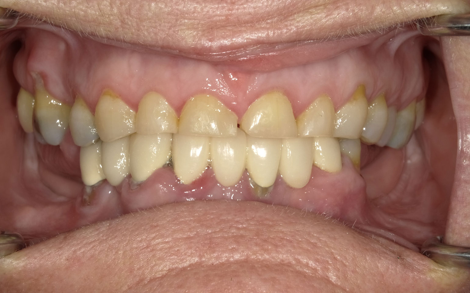 Dental Crowns and Bridges Before