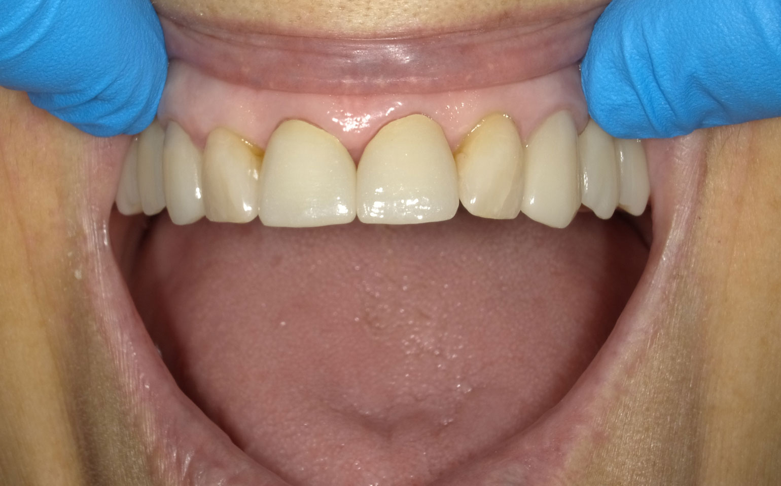 Dental Crowns and Bridges After