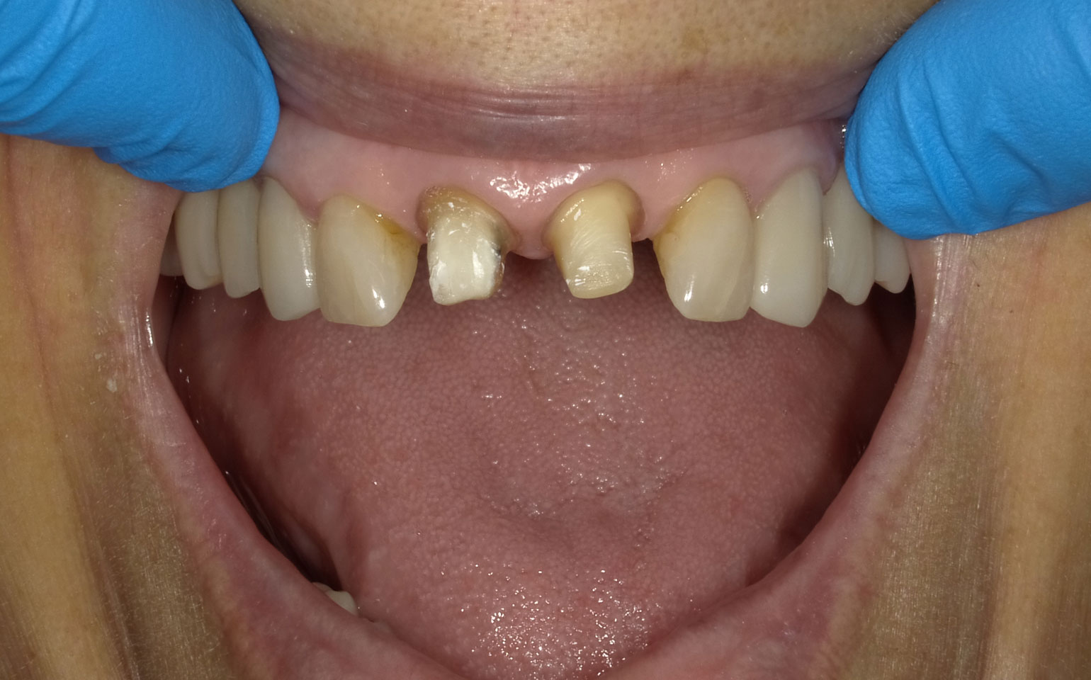 Dental Crowns and Bridges Before