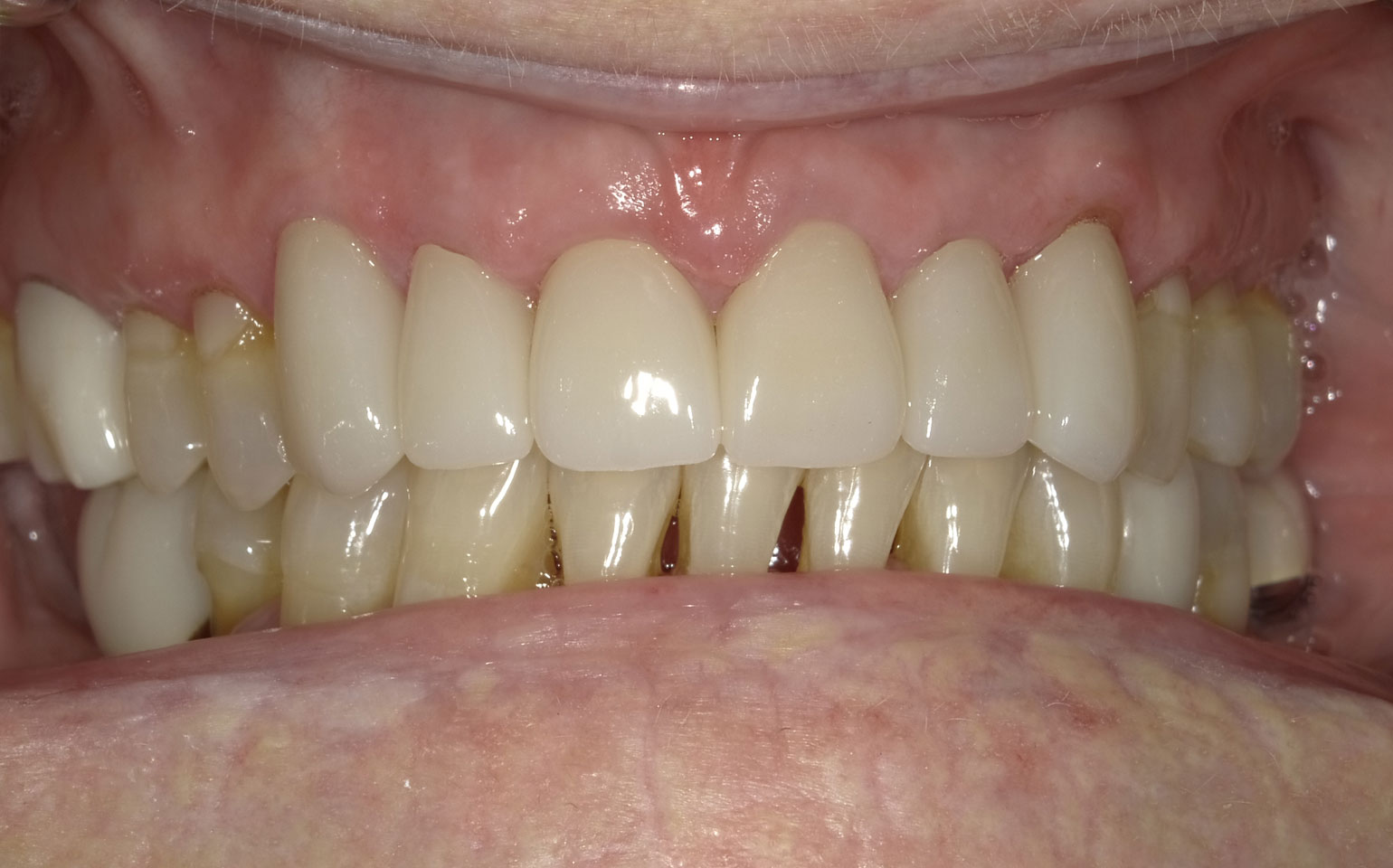 Dental Crowns and Bridges After