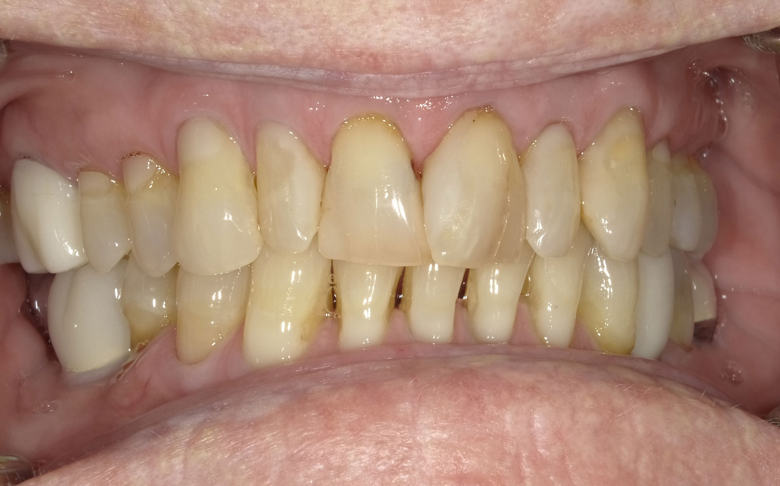 Dental Crowns and Bridges Before